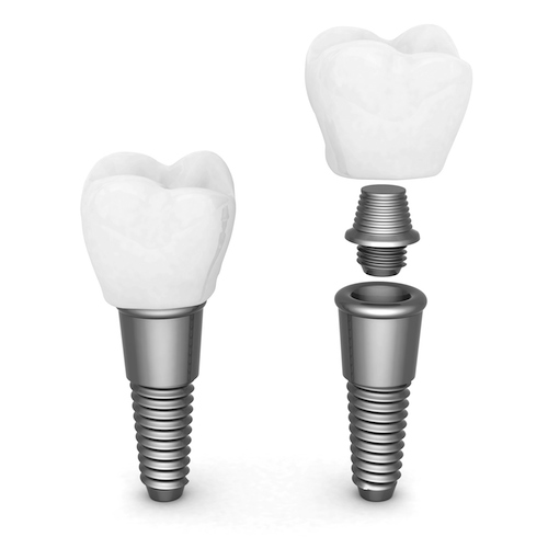 implante dental en Valls Clínica Dental